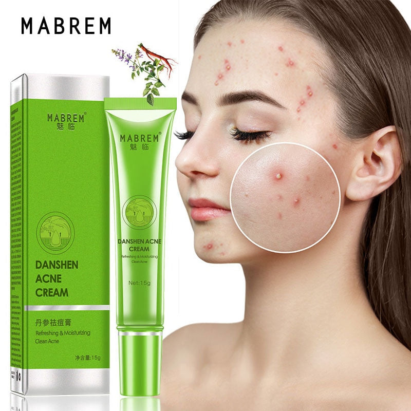 Effective Acne Removal Cream Treatment